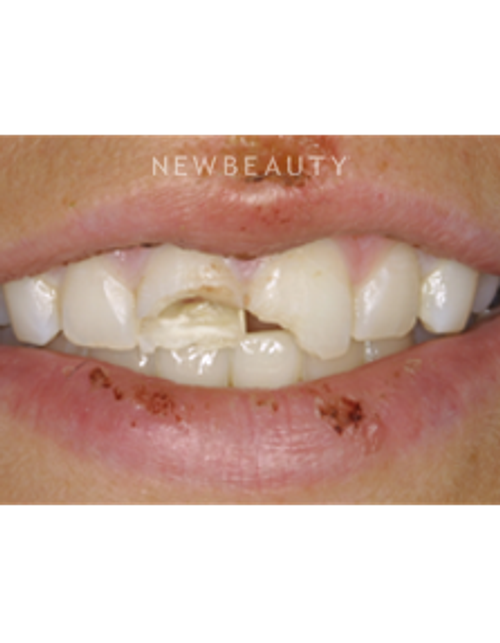 Dr. Joe Kravitz - Smile Makeover - Before