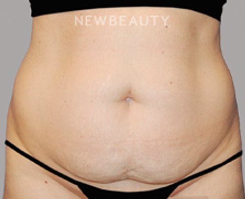 Dr. Carmen Kavali - Restoring Volume - 45241488 - Before