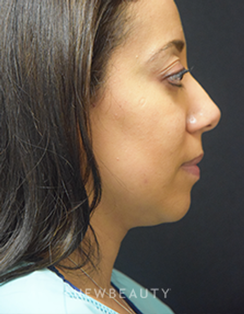 Dr. Jeffrey B. Wise - Kybella - After