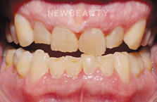 Dr. Joseph Field - Veneers - 20258337 - Before