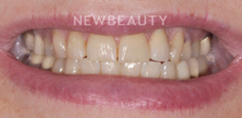 Dr. Salvator La Mastra - Smile Makeover -46107752 - Before