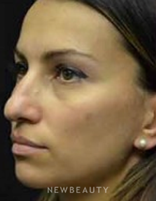 Dr. Aviva Preminger - Rhinoplasty - Before