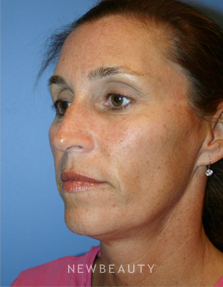 Dr. Kelly Bomer - Chemical Peels - Before