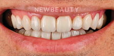 Dr. Husam Almunajed - Veneers - 32080966 - Before