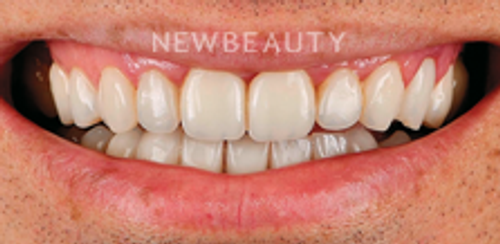 Dr. Husam Almunajed - Veneers - 32080966 - Before