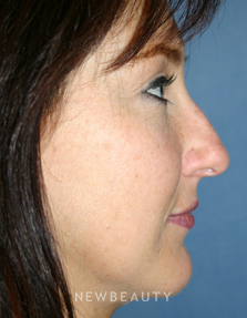 Dr. Kelly Bomer, Rhinoplasty - Before