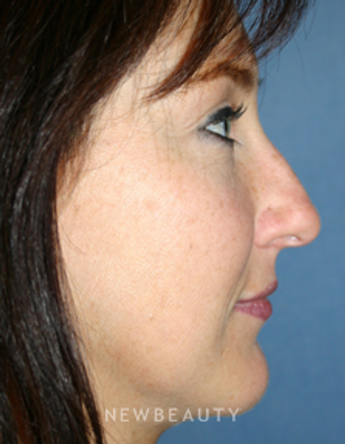 Dr. Kelly Bomer, Rhinoplasty - Before