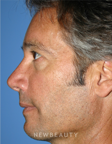 Dr. Kelly Bomer - Liquid Facelift - Before