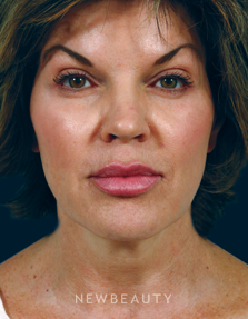 Dr. Kenneth Beer - Restylane - After