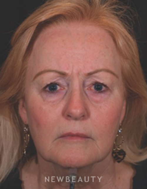 Dr. Kathleen Behr - Facial Rejuvenation - Before