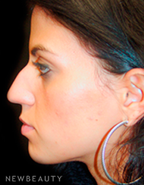 Dr. Mokhtar Asaadi Rhinoplasty - Before