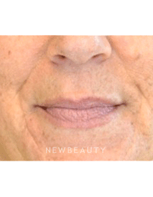 Dr. Julie Russak Injectables & Fillers - Before