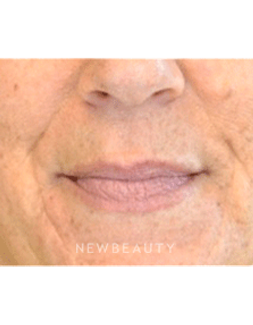 Dr. Julie Russak Injectables & Fillers - Before