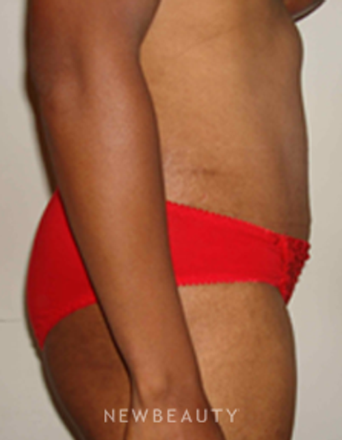 Dr. Michael Horn Tummy Tuck - After
