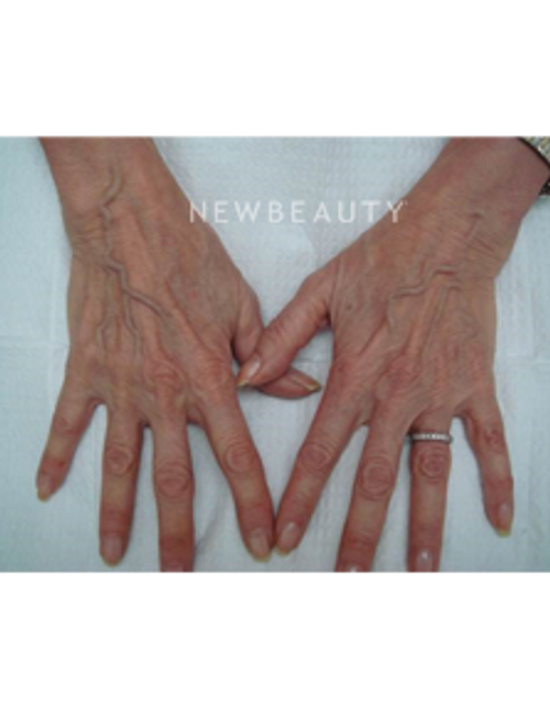 Dr. Doris Day - Injectables & Fillers - Before