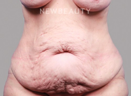 Dr. Michael Lofgren - Tummy Tuck After Weight Loss - 44688404 - Before