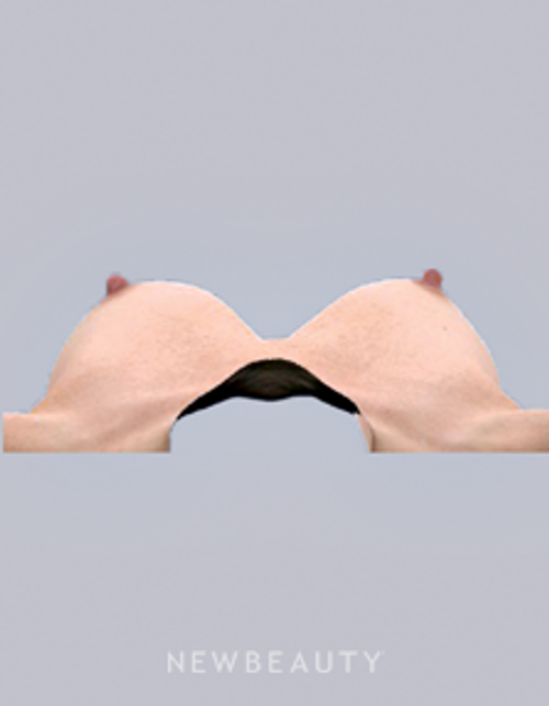 Dr. Bradley Bengtson - Vectra 3D Imaging - Before