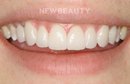 Dr. Joe Kravitz - Veneers - 14082675 - After