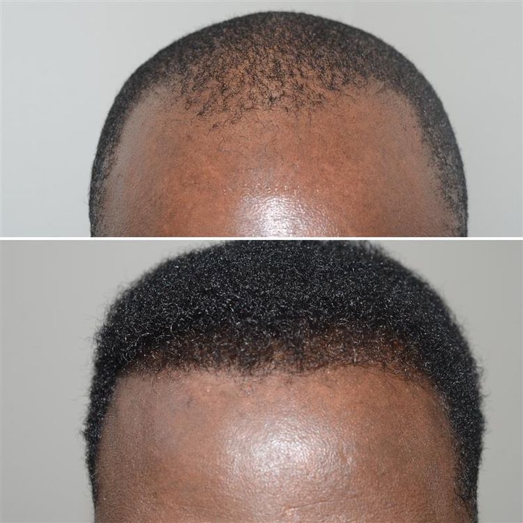 Miami hair restoration surgeon Jeffrey Epstein, MD