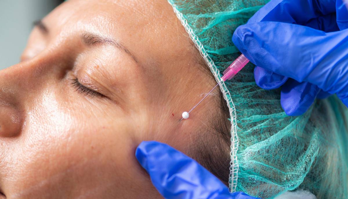 Close-up of a thread lift procedure being performed near a patient’s temple by a provider wearing blue medical gloves.