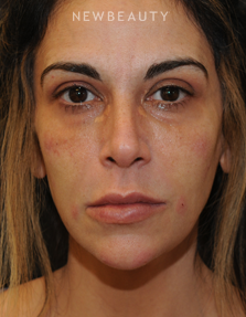 Dr. Janet Allenby - Liquid Rejuvenation - After