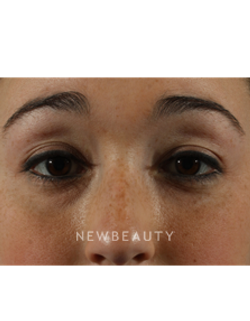 Dr. Marina Peredo - Restylane - After