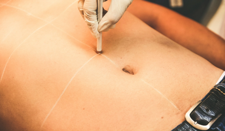 A gloved clinician marks lines across a patient’s abdomen with a pen.