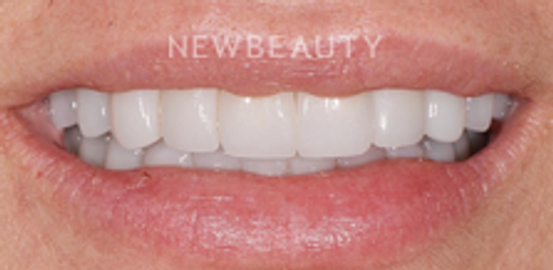 Dr. Salvator La Mastra – Smile Makeover - 46106939 - After