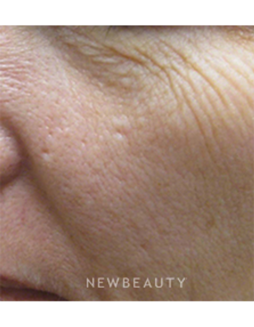 Dr. Kally Papantoniou - Laser Resurfacing - Before