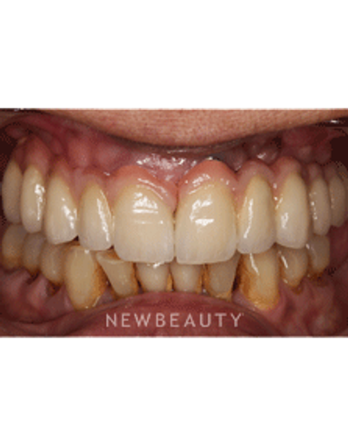 Dr. Neal Patel Smile Makeover - After
