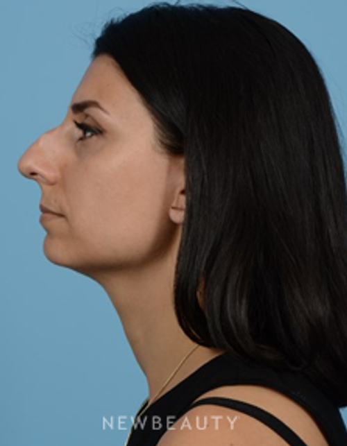 Dr. Jeffrey B. Wise- Rhinoplasty - Before
