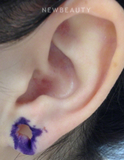 Dr. Kally Papantoniou - Earlobe Repair - Before