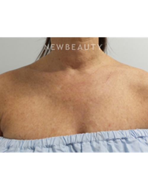 Dr. Marina Peredo - Skinfluence “Trinity Treatment” - After