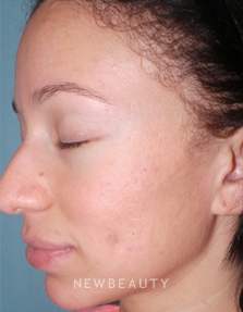 Dr. Sean Simon - Fresh and Clear Skin - After
