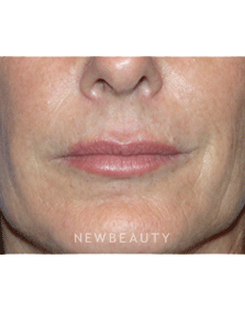 Dr Kelly Bomer Injectable Fillers - After