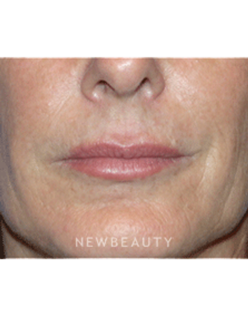 Dr Kelly Bomer Injectable Fillers - After