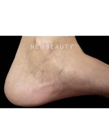 Dr. Jody Levine - Sclerotherapy - Before