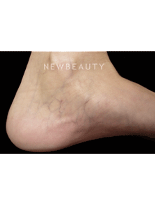 Dr. Jody Levine - Sclerotherapy - Before
