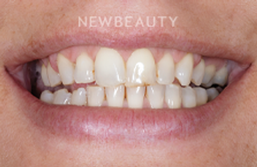 Dr. Robert Klaich - Sparkling Smile - 24010377 - Before