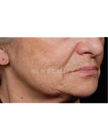 Dr. Ruth Hillelson Lasers, Thermage - Before