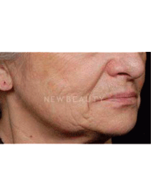 Dr. Ruth Hillelson Lasers, Thermage - Before