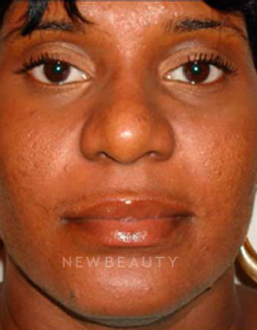 Dr. David Kim Rhinoplasty - After