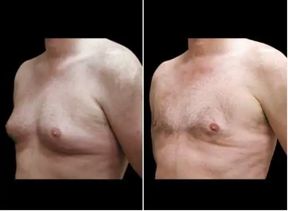 before and after male breast reduction, also known as gynecomastia surgery