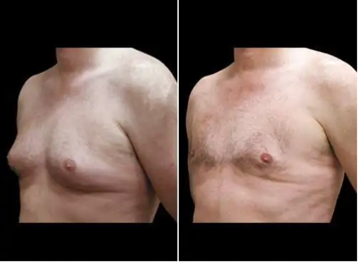 before and after male breast reduction, also known as gynecomastia surgery
