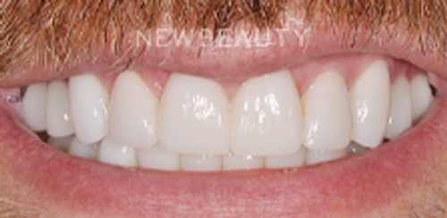 Dr. Salvator La Mastra – Smile Makeover – 46107152 - After