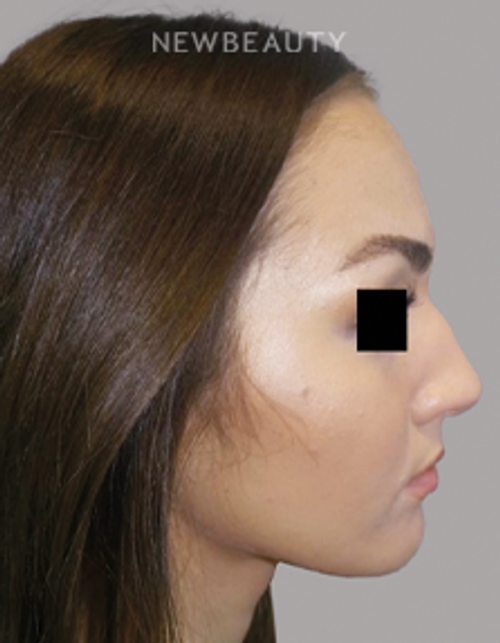 Dr. Sanjay Grover - Rhinoplasty - 49727911 - Before