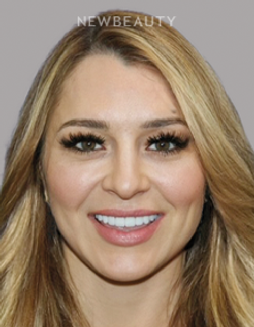 Dr. Salvator La Mastra - Smile Makeover 46109347 - After
