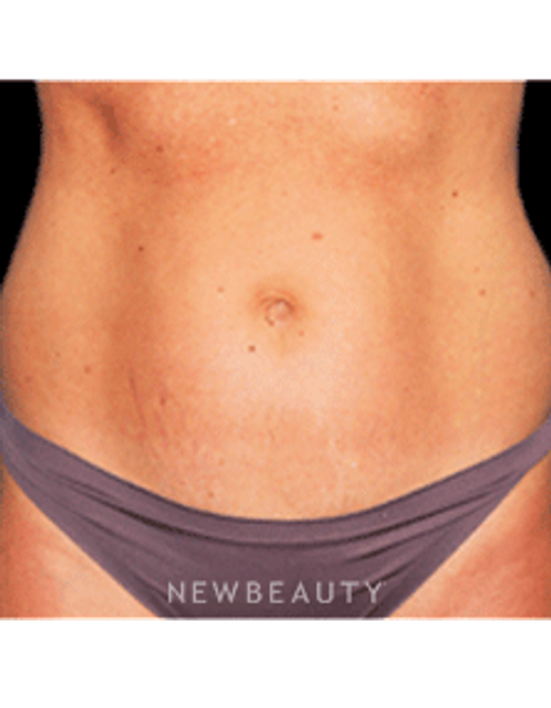 Dr. Bradley Bengtson Liposuction - Before