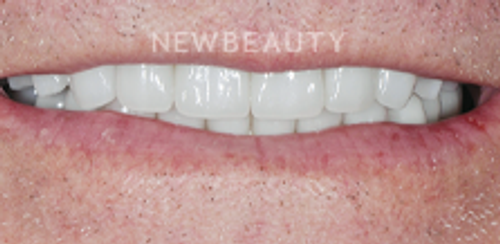 Dr. Salvator La Mastra - Smile Makeover -46106806 - After