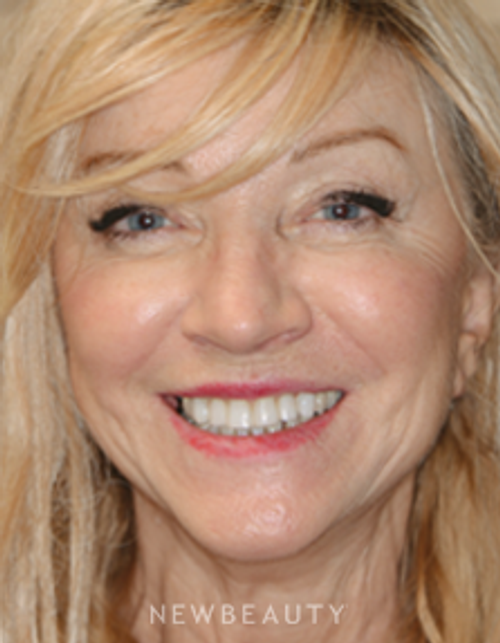 Dr. Irene Grafman - A More Youthful Smile - After